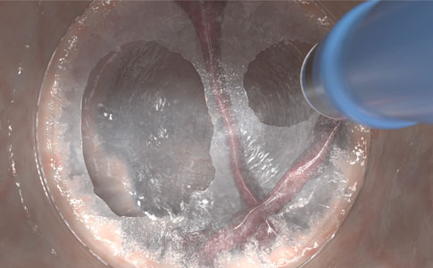 Elektrochirurgische Präzision mit HYBRIDknife® flex: Mit einer 0,5-mm-Elektrode für präzises Schneiden mit minimaler thermischer Schädigung, was für dünnwandige Anatomie wie das rechte Kolon entscheidend ist. Bietet verschiedene distale Spitzenformen für vielseitiges Schneiden, Koagulation und Gewebemanipulation.